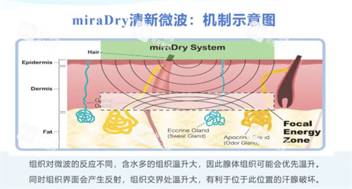 miraDry清新微波机制示意图.jpg miraDry清新微波机制示意图.jpg