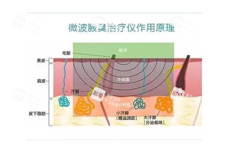 miradry微波治疗原理.png miradry微波治疗原理.png
