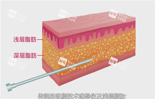 深层脂肪和浅层脂肪 深层脂肪和浅层脂肪