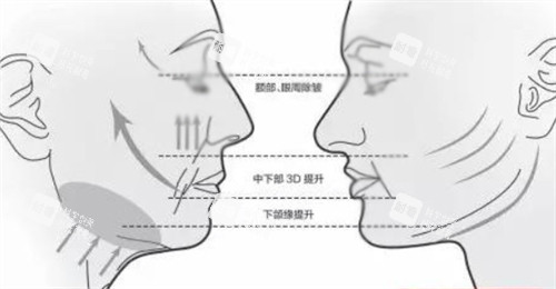 面部提升前后各个部位的对比 面部提升前后各个部位的对比
