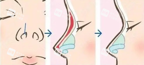 鼻整形图片 鼻整形图片