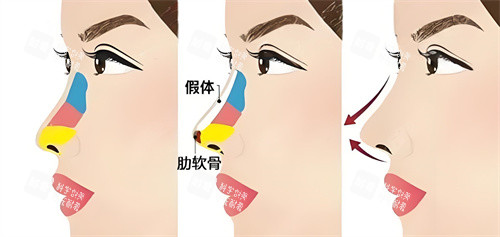 半肋骨隆鼻手术展示动画图.jpg