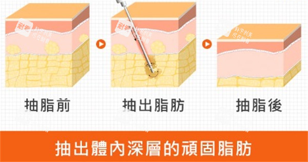 吸脂前后区别.jpg 吸脂前后区别.jpg