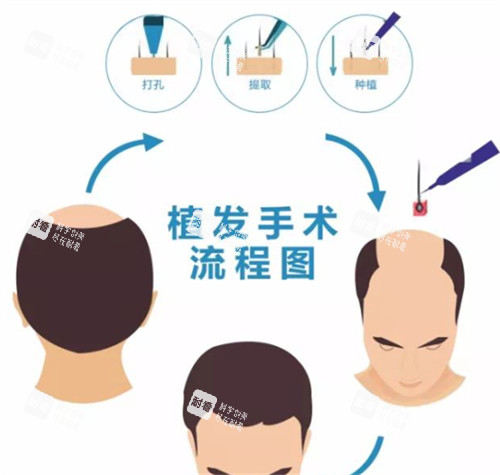 植发手术流程图解 植发手术流程图解