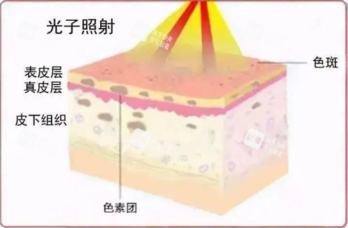 光子嫩肤原理卡通示意图.jpg 光子嫩肤原理卡通示意图.jpg