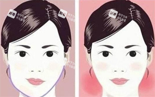 大小脸面部轮廓手术前后对比.jpg