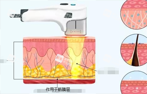 超声治疗作用于筋膜层动画展示.png 超声治疗作用于筋膜层动画展示.png