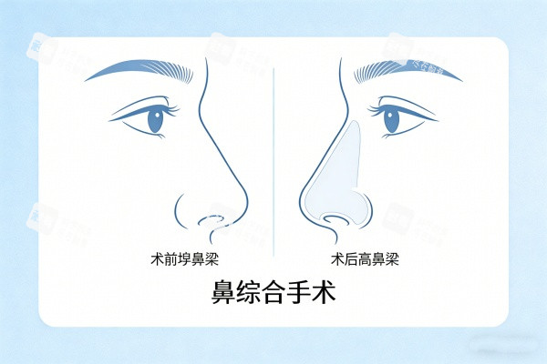 鼻综合手术成效图.jpg 鼻综合手术成效图.jpg