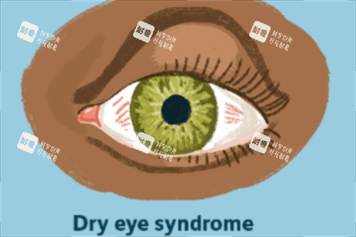 干眼综合征.png 干眼综合征.png