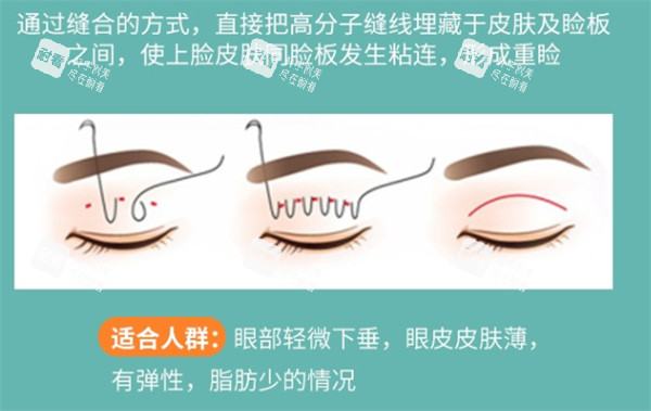 埋线双眼皮解析.jpg 埋线双眼皮解析.jpg