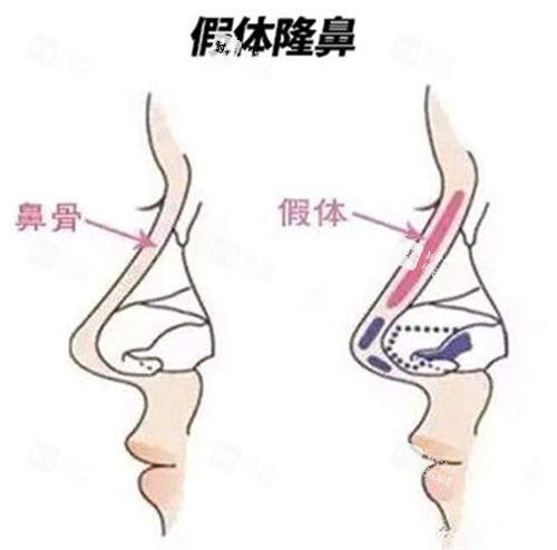 假体隆鼻对比 假体隆鼻对比