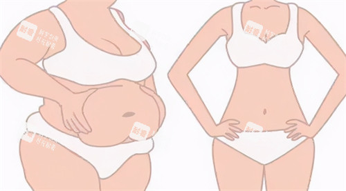 腹部吸脂前后对比过程.jpg 腹部吸脂前后对比过程.jpg