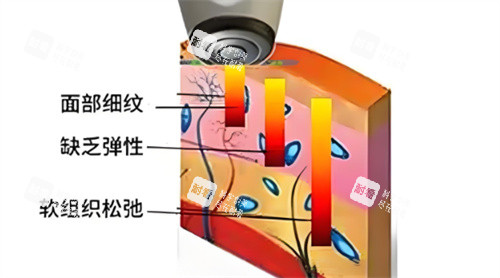 热拉提作用 热拉提作用