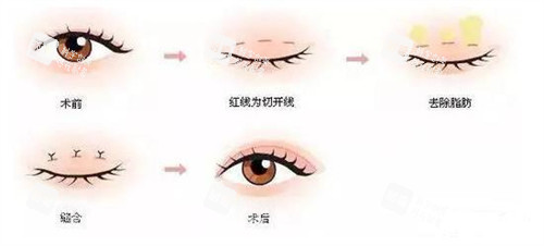 三点定位双眼皮手术过程 三点定位双眼皮手术过程