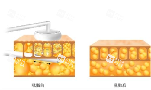 吸脂前后对比图.png 吸脂前后对比图.png