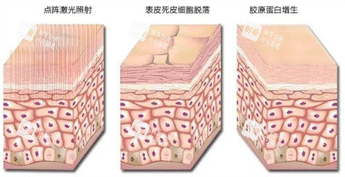 点阵激光过程.jpg