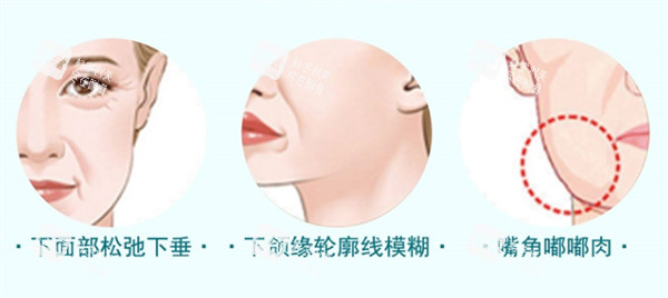 适合埋线提升的情况.jpg 适合埋线提升的情况.jpg