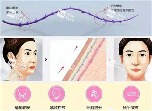 面部埋线提升前后对比图.jpg 面部埋线提升前后对比图.jpg