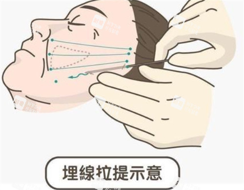 埋线提升面部的操作过程.jpg 埋线提升面部的操作过程.jpg