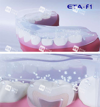 ETA牙齿矫正器.jpg ETA牙齿矫正器.jpg