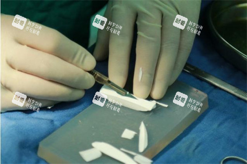 隆鼻手术正在雕刻的膨体.jpg 隆鼻手术正在雕刻的膨体.jpg