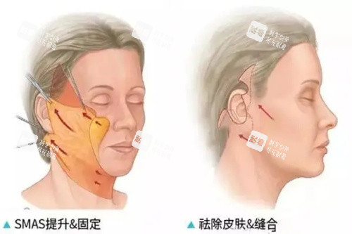 拉皮手术 拉皮手术
