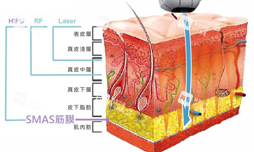 超声炮激光作用原理.jpg 超声炮激光作用原理.jpg
