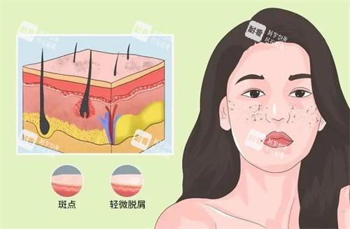 祛斑卡通动画图