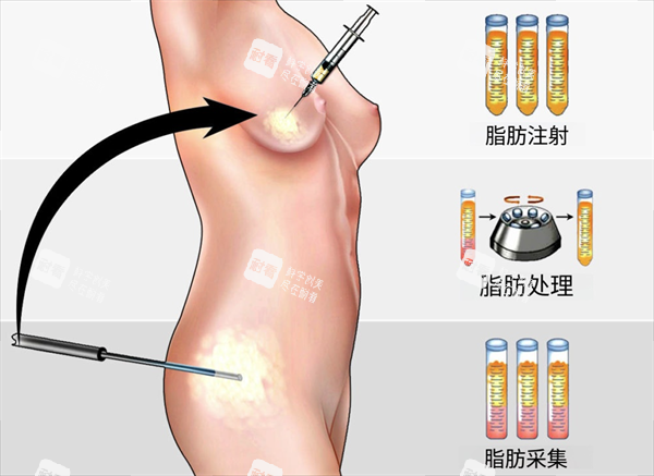 自体脂肪隆胸示意图.png 自体脂肪隆胸示意图.png