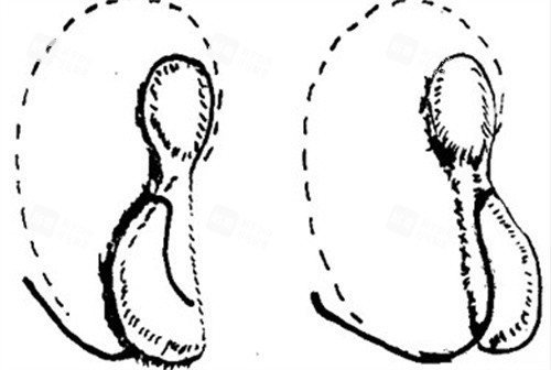 小耳再造手术.jpg 小耳再造手术.jpg