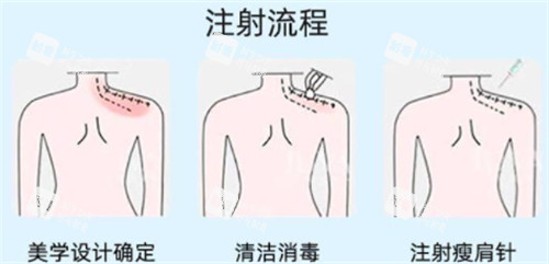 瘦肩注射点位图.jpg 瘦肩注射点位图.jpg