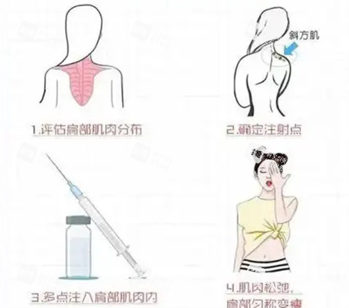 瘦肩注射过程动画图.jpg 瘦肩注射过程动画图.jpg