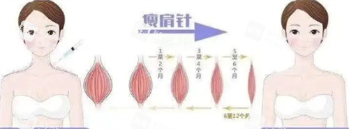 瘦肩针注射过程变化图.jpg 瘦肩针注射过程变化图.jpg