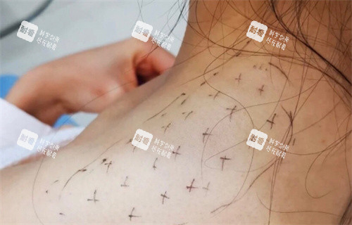 瘦肩注射点位设计图.jpg 瘦肩注射点位设计图.jpg