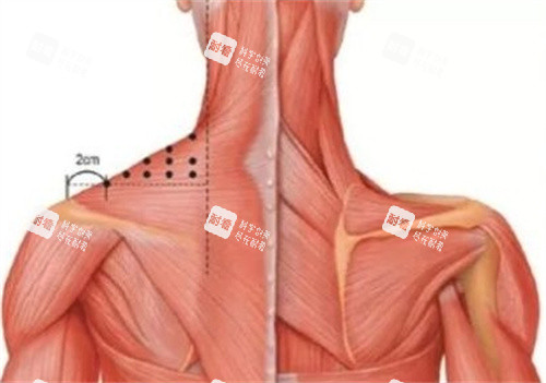 瘦肩针注射肌肉分布图.jpg 瘦肩针注射肌肉分布图.jpg
