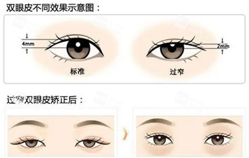 不同高度的双眼皮.jpg
