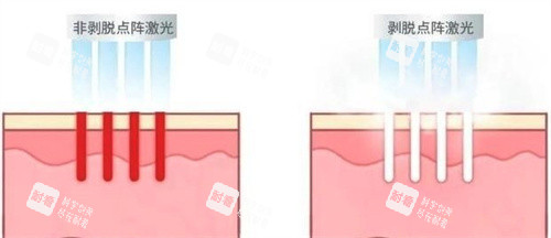 非剥脱和剥脱点阵激光.jpg 非剥脱和剥脱点阵激光.jpg