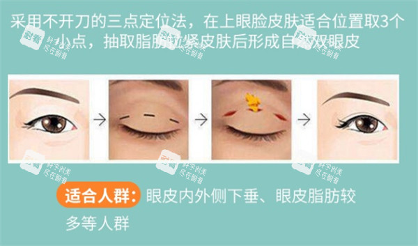 三点双眼皮解析.jpg 三点双眼皮解析.jpg