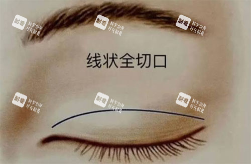 双眼皮失败怎么办.jpg 双眼皮失败怎么办.jpg