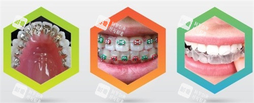 三种不同牙齿矫正牙套示意图.jpg 三种不同牙齿矫正牙套示意图.jpg