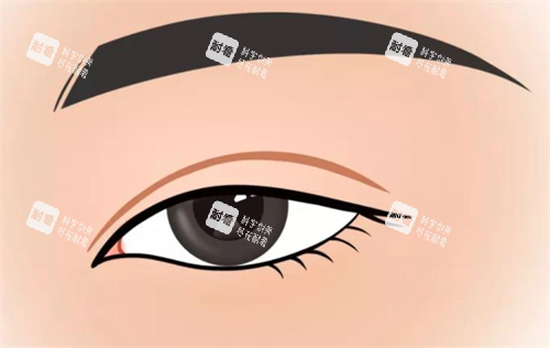 双眼皮手术.png 双眼皮手术.png