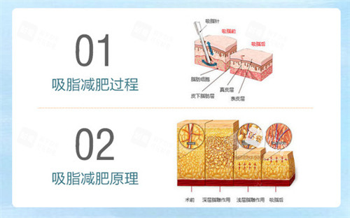 吸脂减肥过程及原理.jpg 吸脂减肥过程及原理.jpg