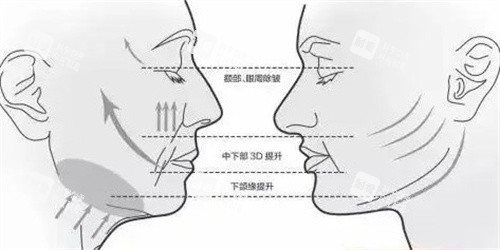 面部提升三大部位.jpg 面部提升三大部位.jpg