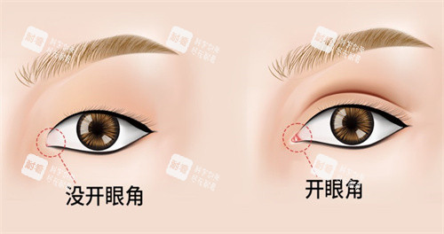 开眼角手术对比.jpg 开眼角手术对比.jpg
