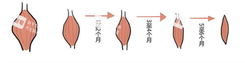 注射瘦腿肌肉缩小.jpg 注射瘦腿肌肉缩小.jpg