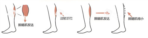 注射瘦腿过程.jpg 注射瘦腿过程.jpg
