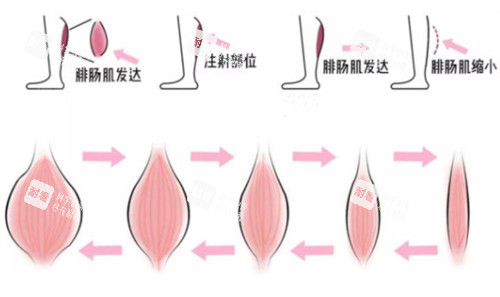瘦腿注射前后对比.jpg 瘦腿注射前后对比.jpg