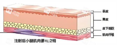 注射瘦腿原理.jpg 注射瘦腿原理.jpg