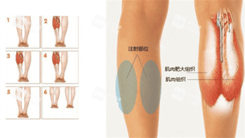 瘦腿注射点位图.jpg 瘦腿注射点位图.jpg