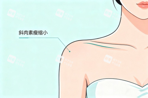 直角肩注射卡通图.jpg 直角肩注射卡通图.jpg
